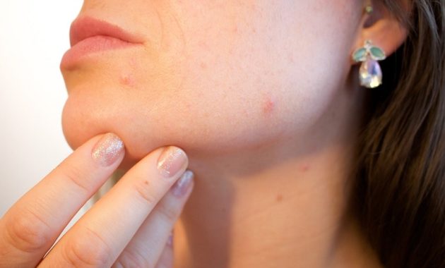 Skincare untuk Kulit Berjerawat, Simak Kandungan Pentingnya