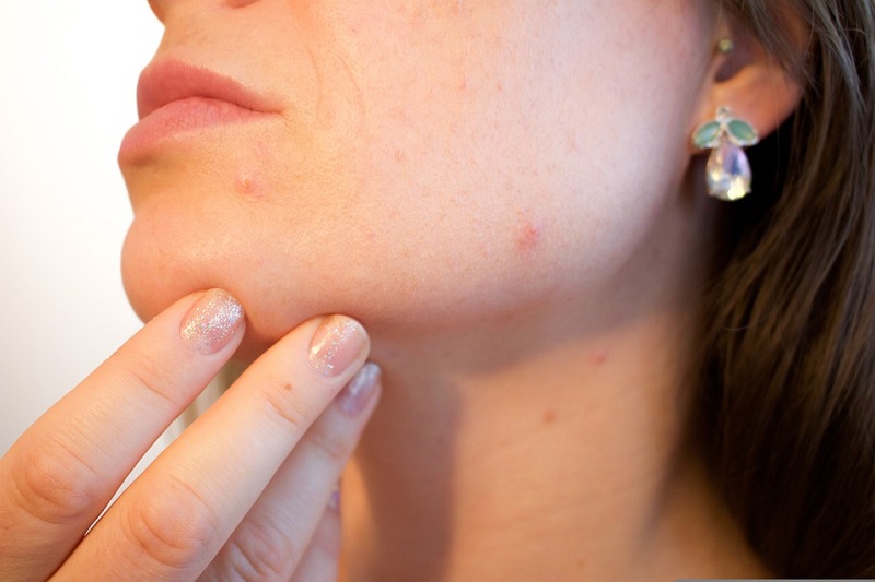 Skincare untuk Kulit Berjerawat, Simak Kandungan Pentingnya 